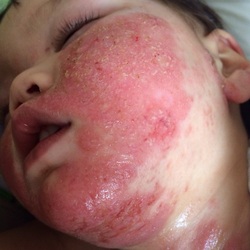 Topical steroid induced eczema